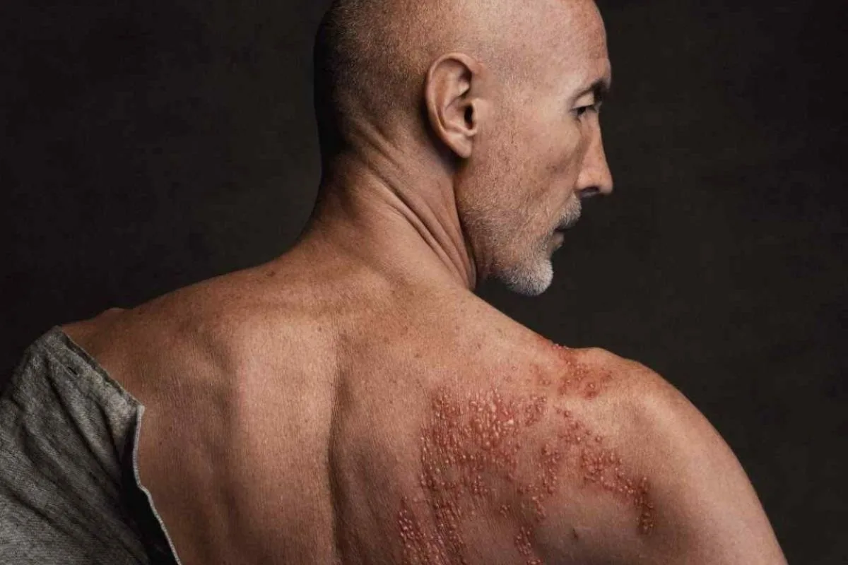 Έρπητας Ζωστήρας 4