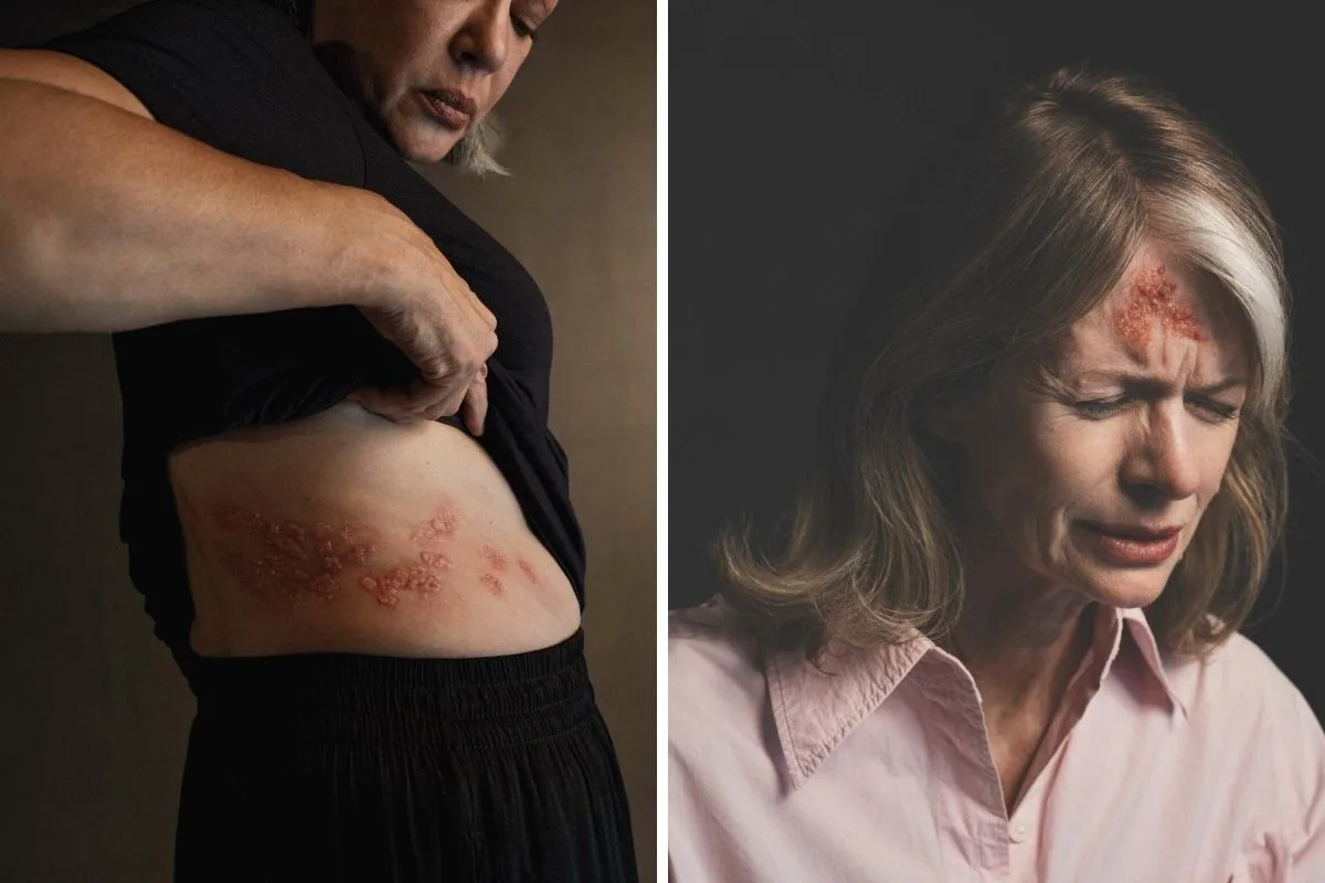 Έρπητας Ζωστήρας 6