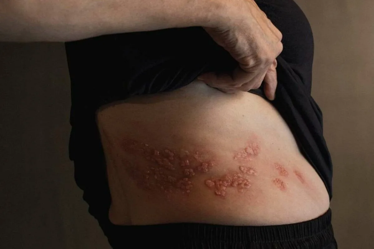 Έρπητας Ζωστήρας 3