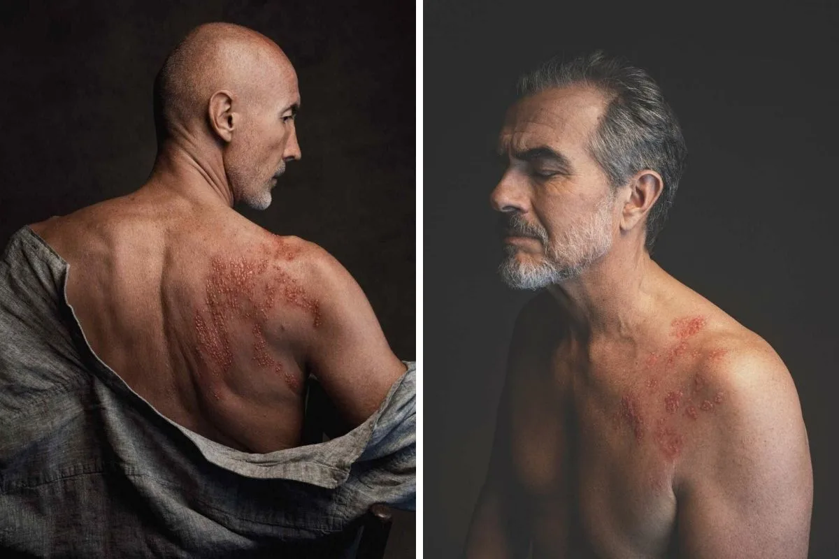 Έρπητας Ζωστήρας 2