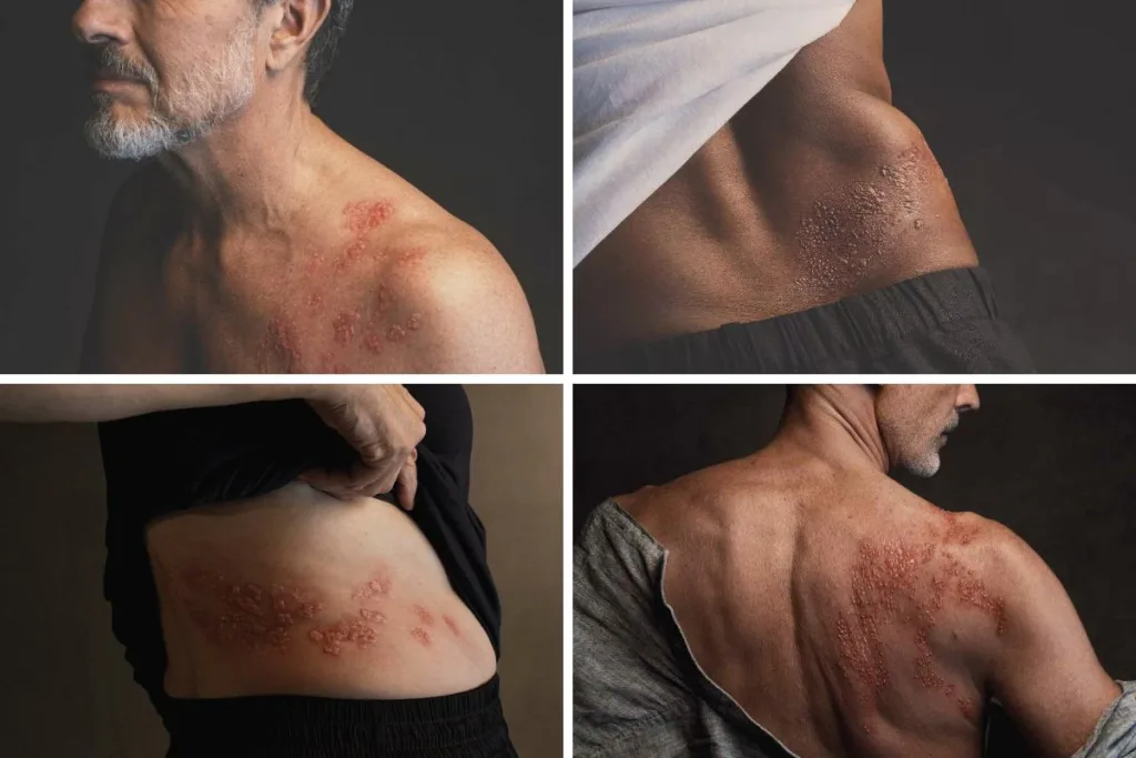 Έρπητας Ζωστήρας/ cover foto